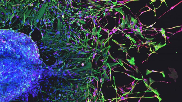 Cellules souches issues de glioblastome humain, regroupées en une neurosphère